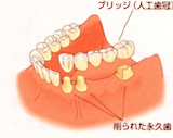 従来のブリッジによる治療