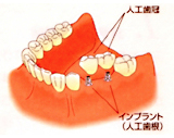 インプラント治療