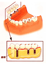 インプラント治療