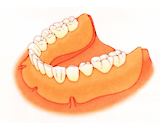 従来の総入れ歯